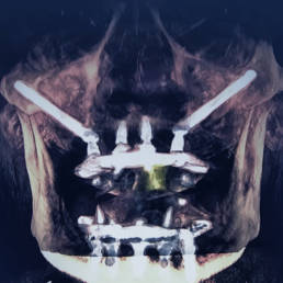 Implante Zigomático