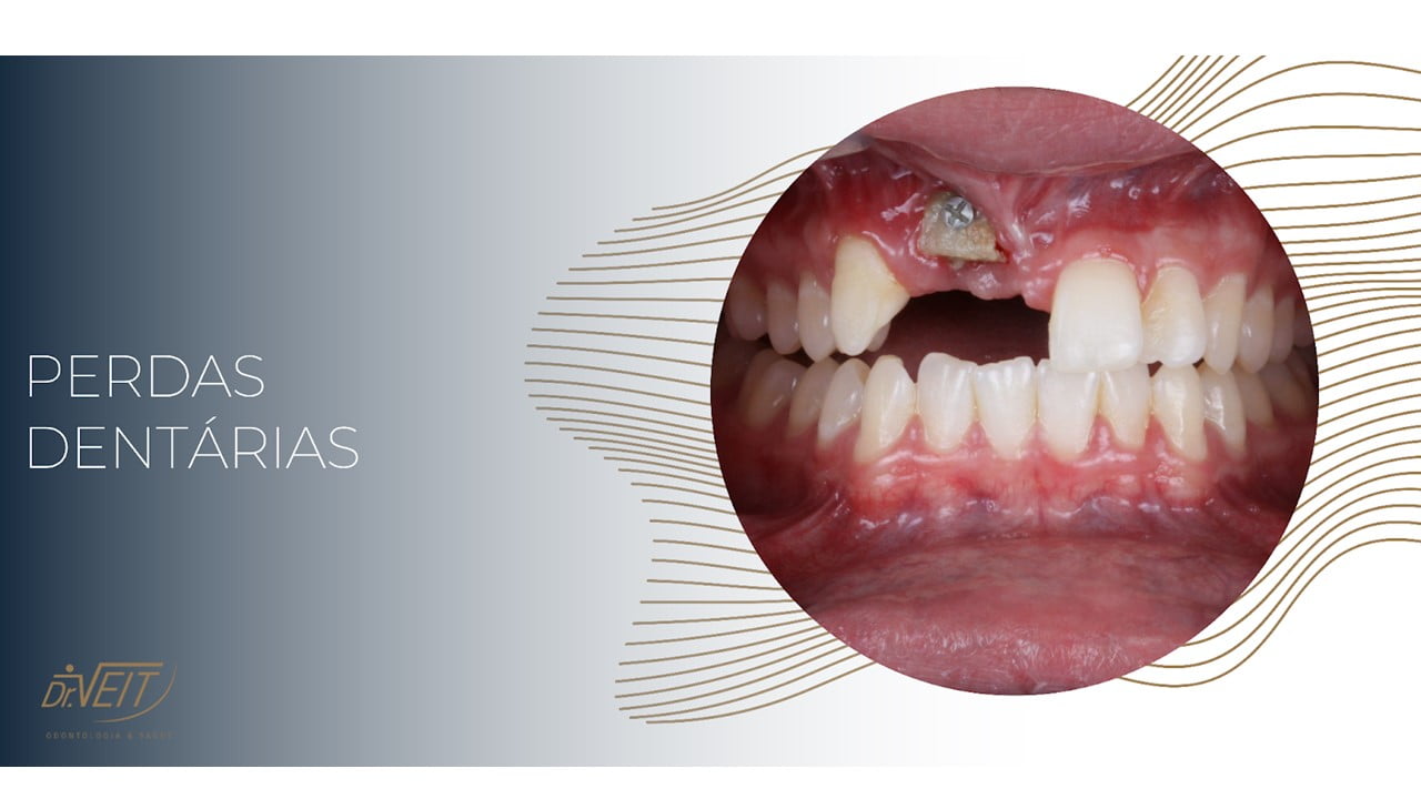Perdas dentárias
