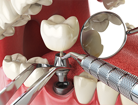 Como é feita a manutenção de um implante dentário