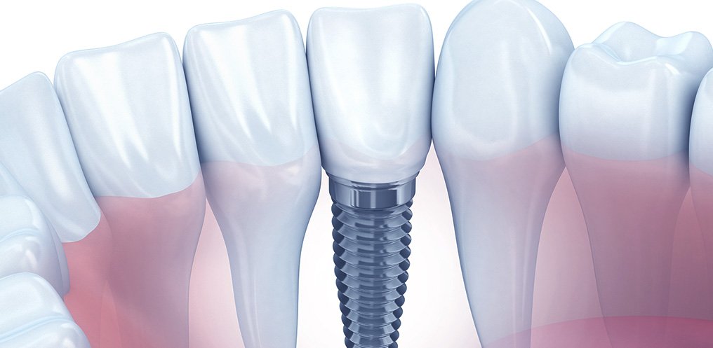 Como é feita a manutenção de um implante dentário