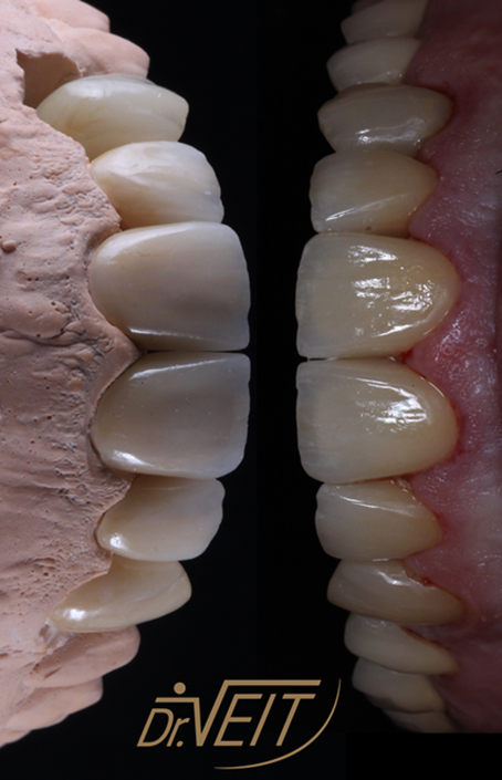 Lentes de contato dentais - tema do Dr. Veit na Inesquecível Casamento