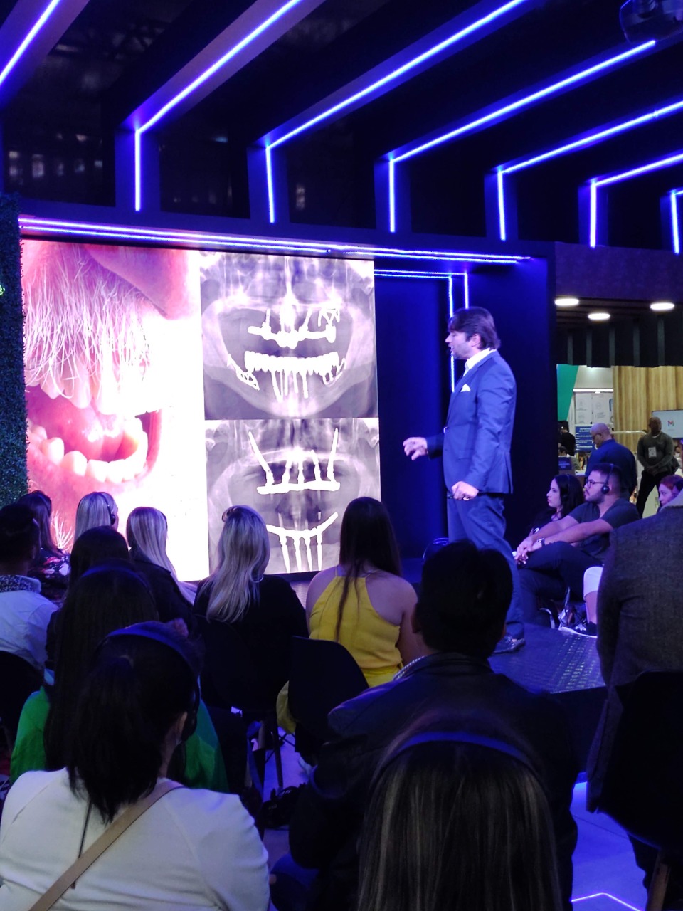 Implantes Zigomáticos - Carga Imediata