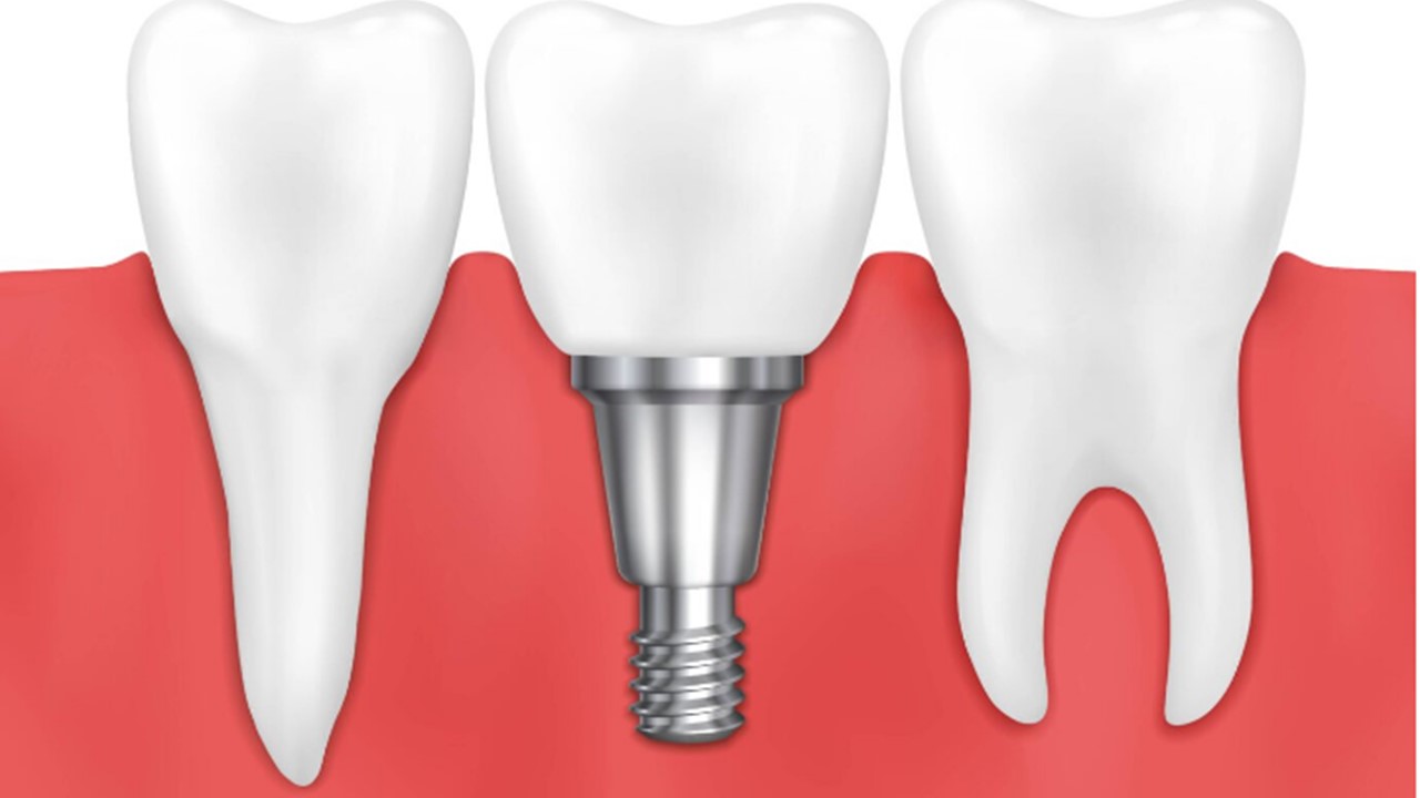 Tudo sobre Implantes Dentários