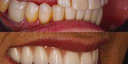 implantes dentários