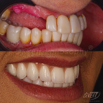 implantes dentários