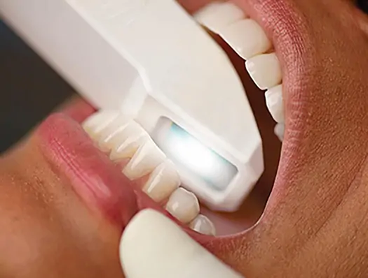 Scanner Intra-oral
