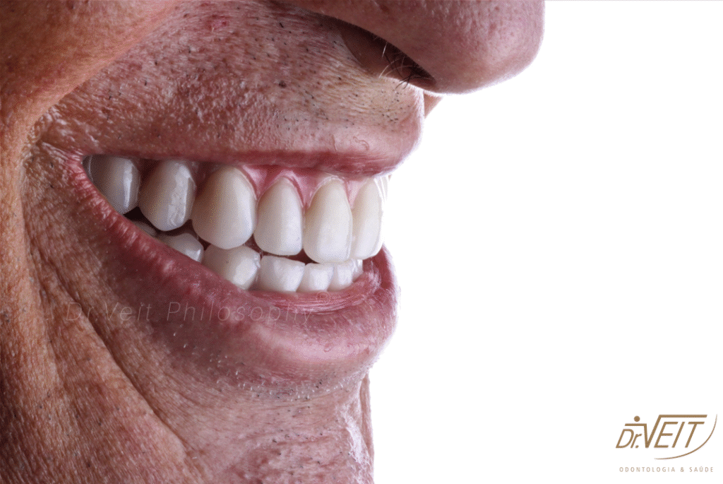 implantes dentarios