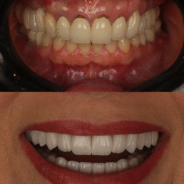 lente de contato dental em Higienópolis