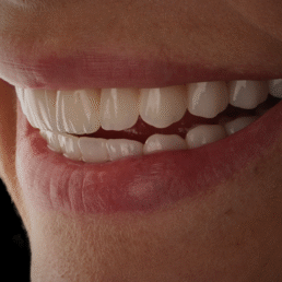 lentes de contato dental no Jardins