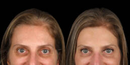 lentes de contato dental em pinheiros