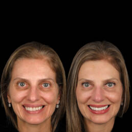 lentes de contato dental em pinheiros