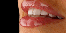 lentes de contato dental em Pinheiros