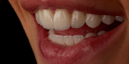 Lentes de contato dental no Itaim