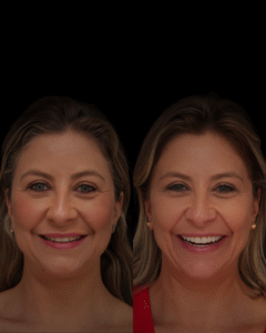 lentes de contato dental em Moema