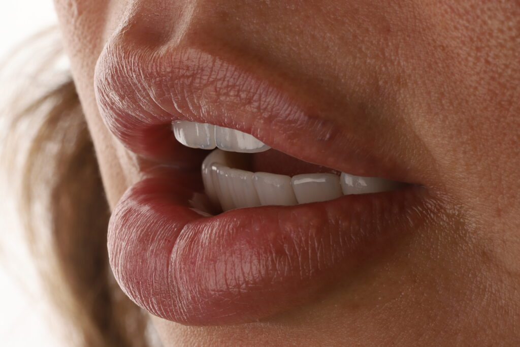 lentes-de-contato-dental-no-Brooklin