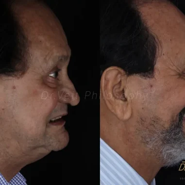 carga-imediata-veit-3