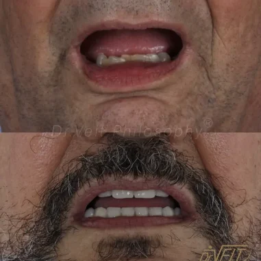 carga-imediata-veit-4