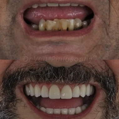 carga-imediata-veit-5