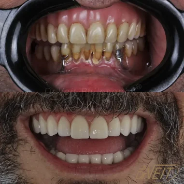 carga-imediata-veit-6