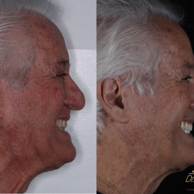 https_drveit.com.br_casos-clinicos_protocolo-de-zirconia-sobre-implantes-com-carga-imediata-10__2