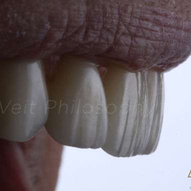 https_drveit.com.br_casos-clinicos_protocolo-de-zirconia-sobre-implantes-com-carga-imediata-10__4
