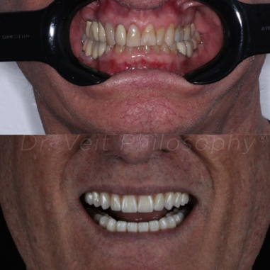 https_drveit.com.br_casos-clinicos_protocolo-de-zirconia-sobre-implantes-com-carga-imediata-10__5