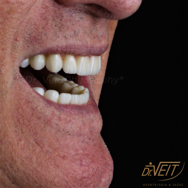 https_drveit.com.br_casos-clinicos_protocolo-de-zirconia-sobre-implantes-com-carga-imediata-10__6