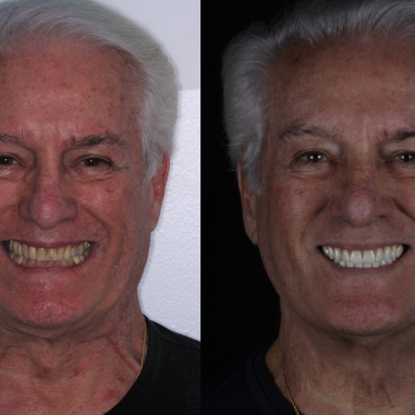 https_drveit.com.br_casos-clinicos_protocolo-de-zirconia-sobre-implantes-com-carga-imediata-10__8