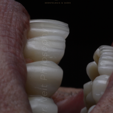 https_drveit.com.br_casos-clinicos_protocolo-de-zirconia-sobre-implantes-com-carga-imediata-10__9