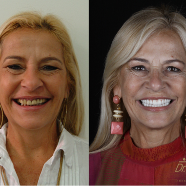 https_drveit.com.br_casos-clinicos_protocolo-de-zirconia-sobre-implantes-com-carga-imediata-11__1