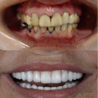 https_drveit.com.br_casos-clinicos_protocolo-de-zirconia-sobre-implantes-com-carga-imediata-11__10