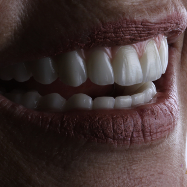 https_drveit.com.br_casos-clinicos_protocolo-de-zirconia-sobre-implantes-com-carga-imediata-11__2