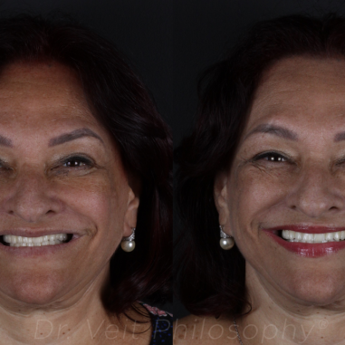 https_drveit.com.br_casos-clinicos_protocolo-de-zirconia-sobre-implantes-com-carga-imediata-14__1