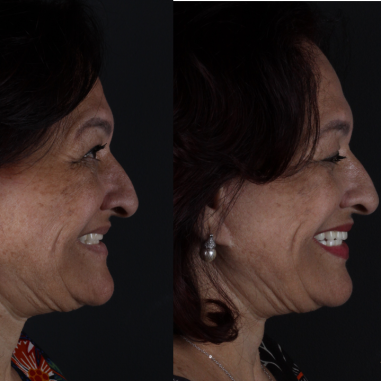 https_drveit.com.br_casos-clinicos_protocolo-de-zirconia-sobre-implantes-com-carga-imediata-14__2