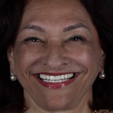 https_drveit.com.br_casos-clinicos_protocolo-de-zirconia-sobre-implantes-com-carga-imediata-14__3