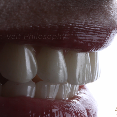 https_drveit.com.br_casos-clinicos_protocolo-de-zirconia-sobre-implantes-com-carga-imediata-14__5