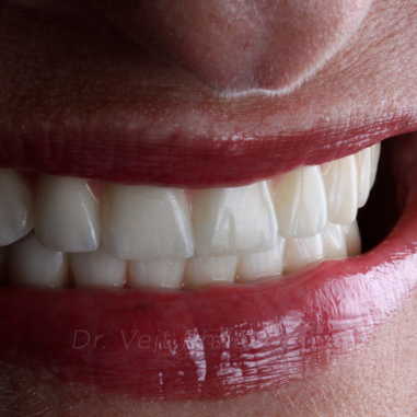 https_drveit.com.br_casos-clinicos_protocolo-de-zirconia-sobre-implantes-com-carga-imediata-14__6