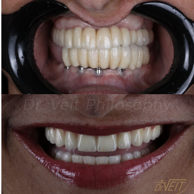 https_drveit.com.br_casos-clinicos_protocolo-de-zirconia-sobre-implantes-com-carga-imediata-14__7