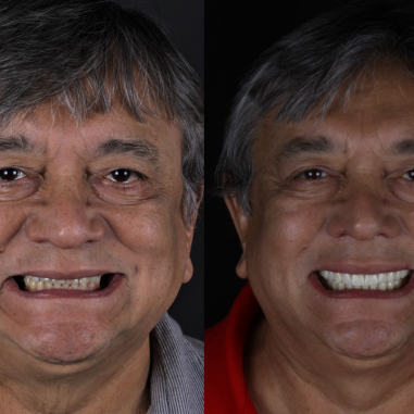 https_drveit.com.br_casos-clinicos_protocolo-de-zirconia-sobre-implantes-com-carga-imediata-15__1