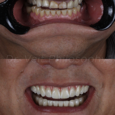 https_drveit.com.br_casos-clinicos_protocolo-de-zirconia-sobre-implantes-com-carga-imediata-15__2