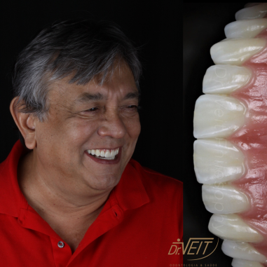 https_drveit.com.br_casos-clinicos_protocolo-de-zirconia-sobre-implantes-com-carga-imediata-15__4