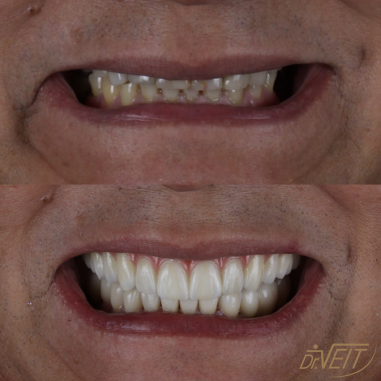 https_drveit.com.br_casos-clinicos_protocolo-de-zirconia-sobre-implantes-com-carga-imediata-15__7