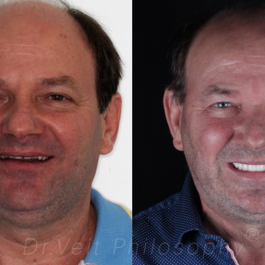 https_drveit.com.br_casos-clinicos_protocolo-de-zirconia-sobre-implantes-com-carga-imediata-17__2