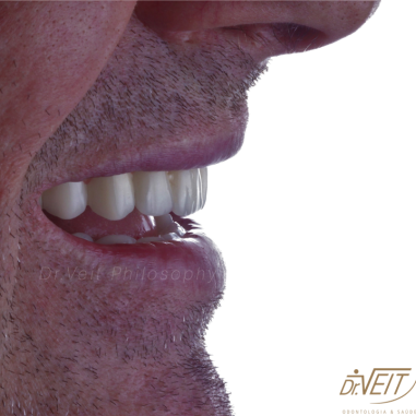 https_drveit.com.br_casos-clinicos_protocolo-de-zirconia-sobre-implantes-com-carga-imediata-17__3