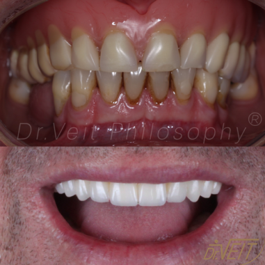 https_drveit.com.br_casos-clinicos_protocolo-de-zirconia-sobre-implantes-com-carga-imediata-17__5