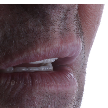 https_drveit.com.br_casos-clinicos_protocolo-de-zirconia-sobre-implantes-com-carga-imediata-17__6