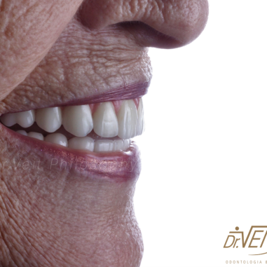 https_drveit.com.br_casos-clinicos_protocolo-de-zirconia-sobre-implantes-com-carga-imediata-5__3