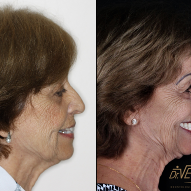 https_drveit.com.br_casos-clinicos_protocolo-de-zirconia-sobre-implantes-com-carga-imediata-5__6