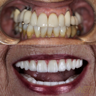 https_drveit.com.br_casos-clinicos_protocolo-de-zirconia-sobre-implantes-com-carga-imediata-5__8