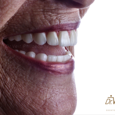 https_drveit.com.br_casos-clinicos_protocolo-de-zirconia-sobre-implantes-com-carga-imediata-5__9